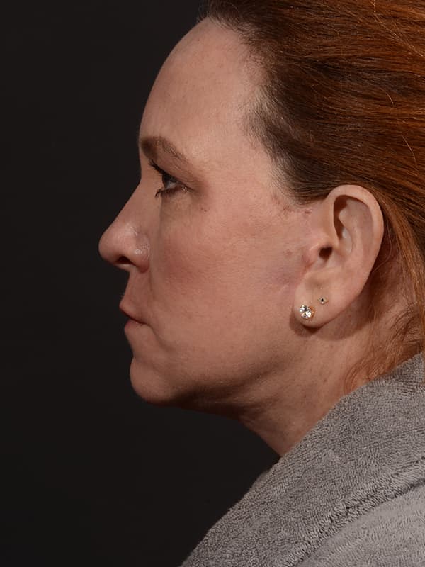 Face and Neck Lift Before & After Image