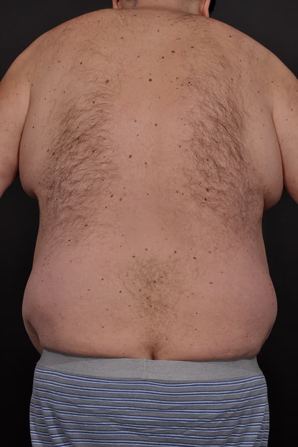 Male Abdominoplasty Before & After Image