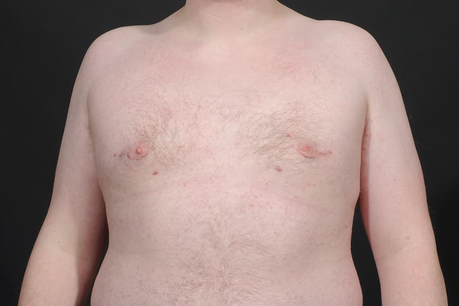 Male Breast Reduction Before & After Image