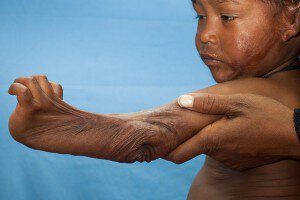 Elbow and hand burn contracture, before the surgery