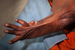 Hand burn contracture, before the surgery