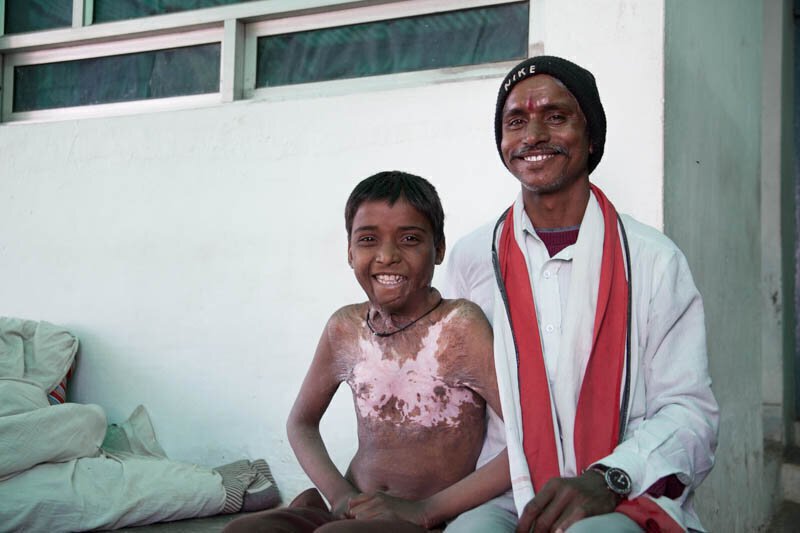 Patient one year after trapezius flap surgery.