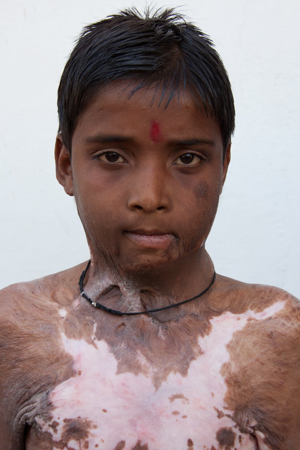 Burn patient one year after surgery