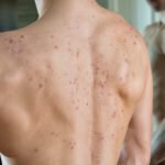 Worse than Acne: Bacne