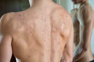 Worse than Acne: Bacne