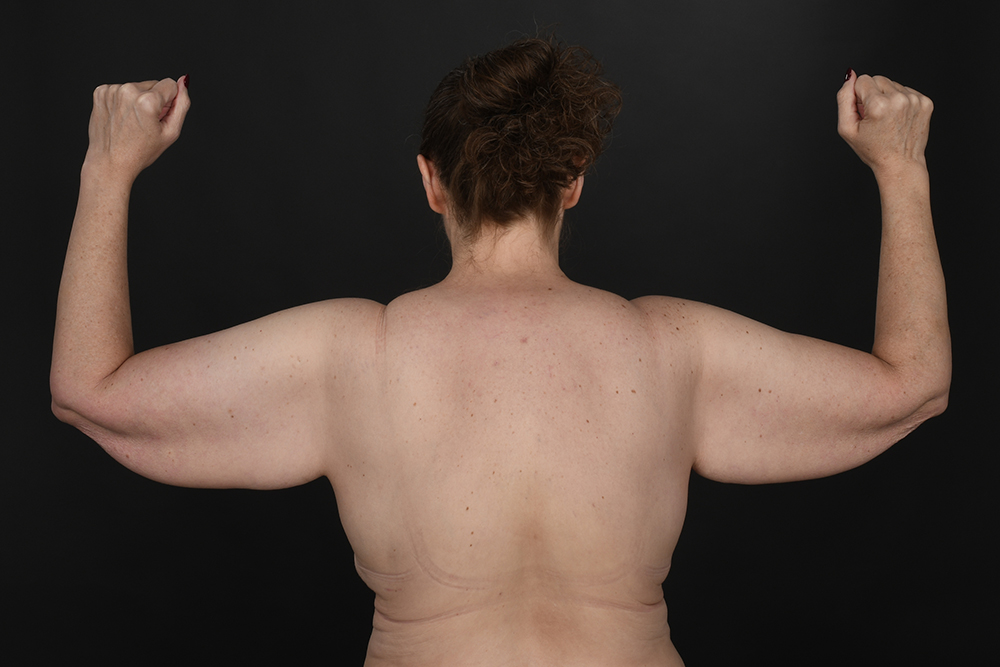 Brachioplasty Before & After Image