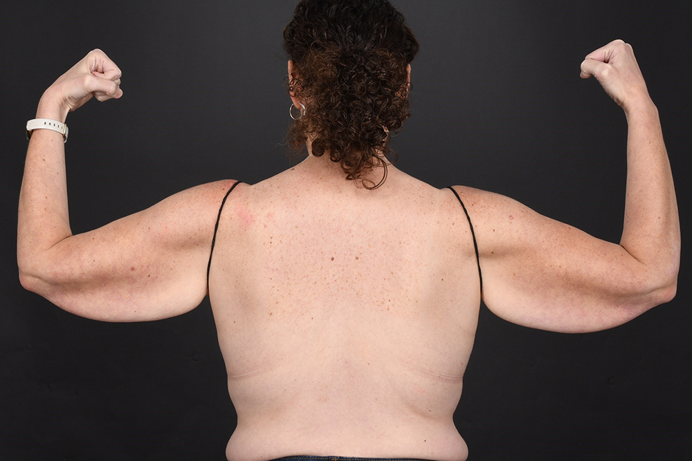 Brachioplasty Before & After Image