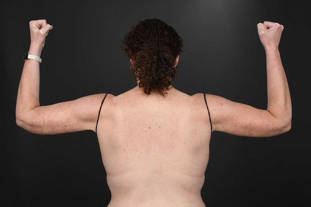 Brachioplasty Before & After Image