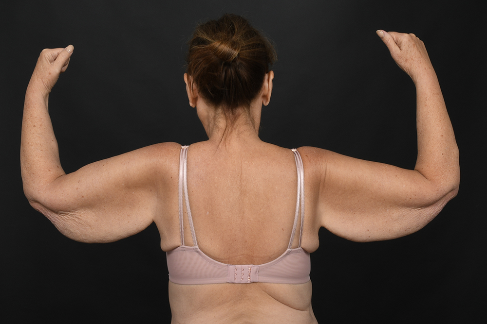 Brachioplasty Before & After Image