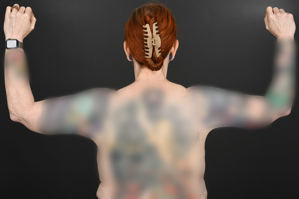 Brachioplasty Before & After Image