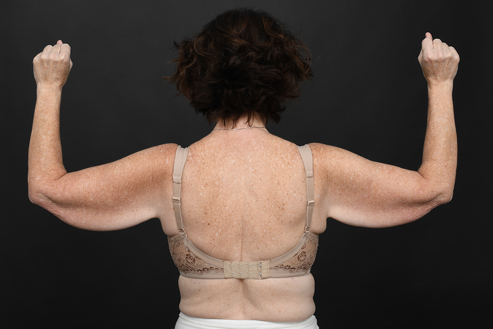 Brachioplasty Before & After Image
