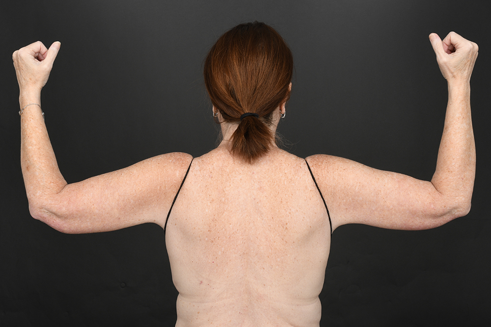 Brachioplasty Before & After Image