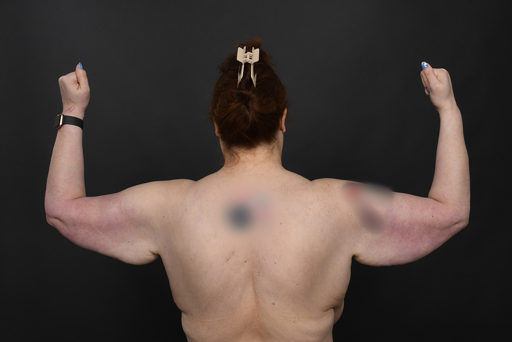 Brachioplasty Before & After Image