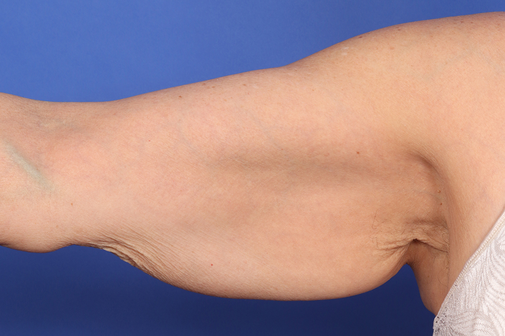 Brachioplasty Before & After Image