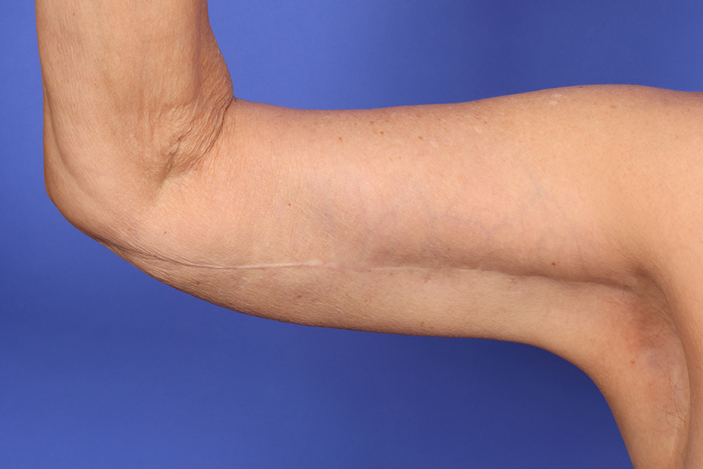Brachioplasty Before & After Image