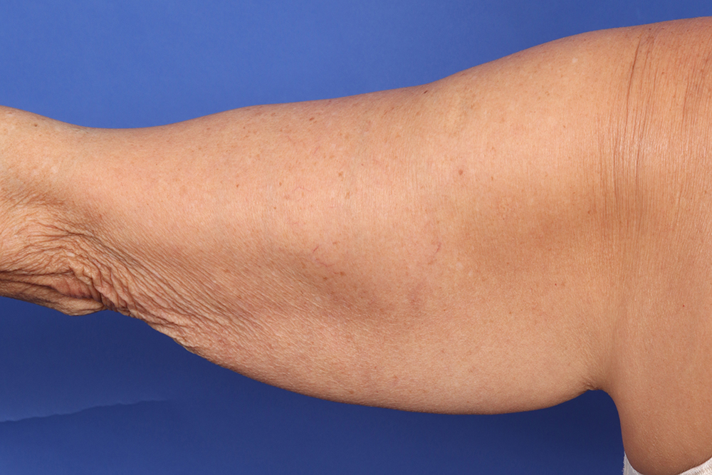 Brachioplasty Before & After Image
