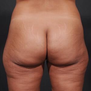 Brazilian Butt Lift Before & After Image