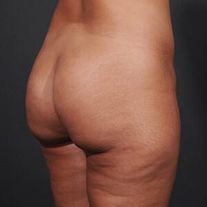 Brazilian Butt Lift Before & After Image