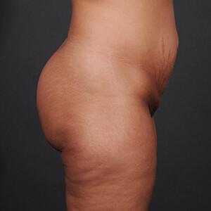 Brazilian Butt Lift Before & After Image