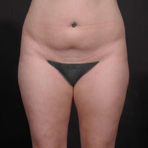 Liposuction Before & After Image