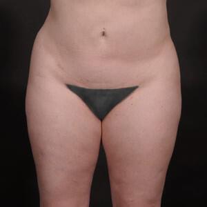 Liposuction Before & After Image