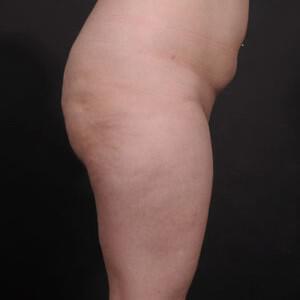 Liposuction Before & After Image