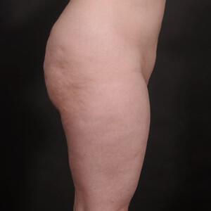 Liposuction Before & After Image