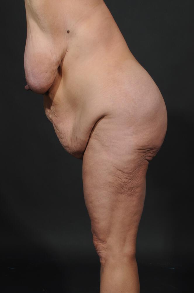 Mommy Makeover Before & After Image