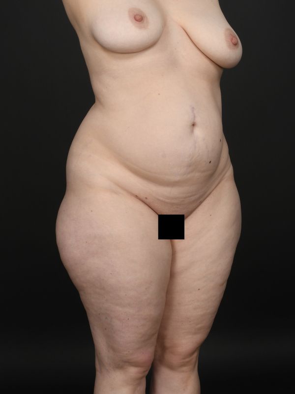 Mommy Makeover Before & After Image