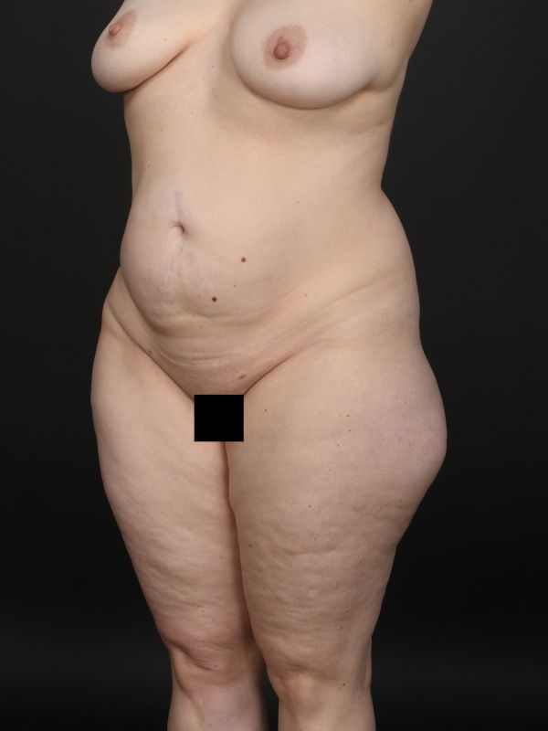 Mommy Makeover Before & After Image