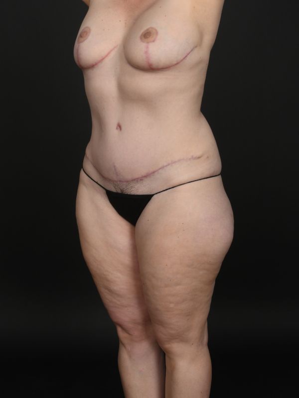 Mommy Makeover Before & After Image