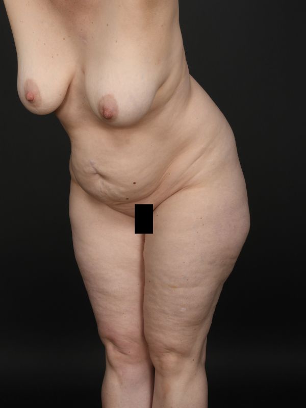 Mommy Makeover Before & After Image