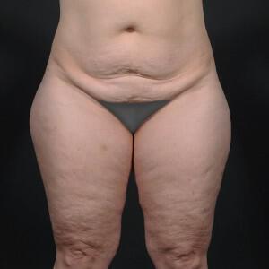 Thigh Lift Before & After Image