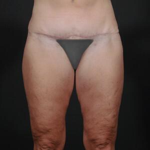 Thigh Lift Before & After Image