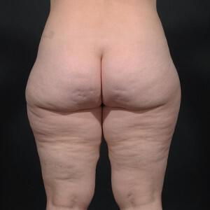 Thigh Lift Before & After Image