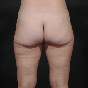 Thigh Lift Before & After Image