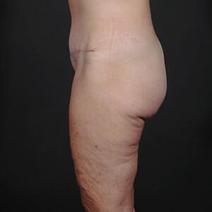 Thigh Lift Before & After Image