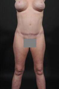 Tummy Tuck with Hernia Repair Before & After Image