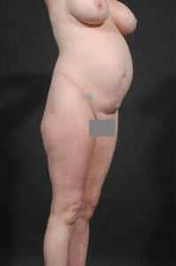 Tummy Tuck with Hernia Repair Before & After Image