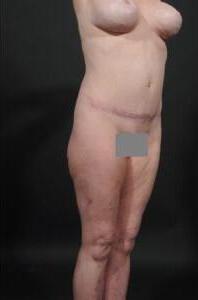 Tummy Tuck with Hernia Repair Before & After Image