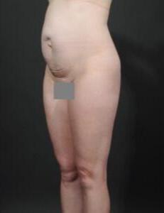 Tummy Tuck with Hernia Repair Before & After Image