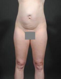 Tummy Tuck with Hernia Repair Before & After Image