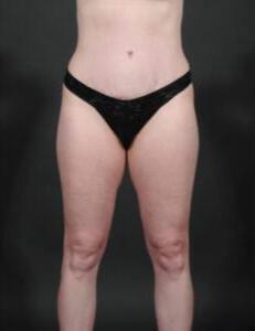 Tummy Tuck with Hernia Repair Before & After Image