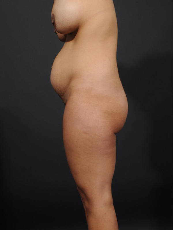 Tummy Tuck with Hernia Repair Before & After Image