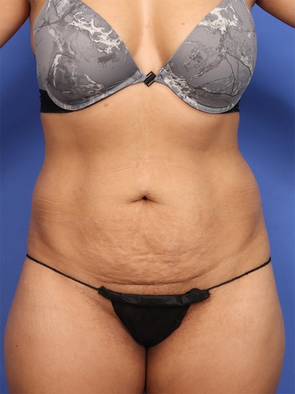 Tummy Tuck with Hernia Repair Before & After Image