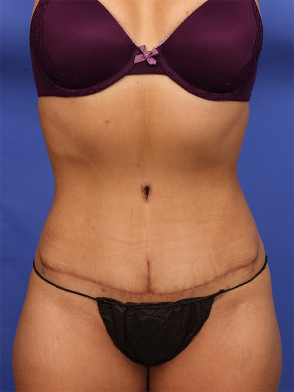 Tummy Tuck with Hernia Repair Before & After Image