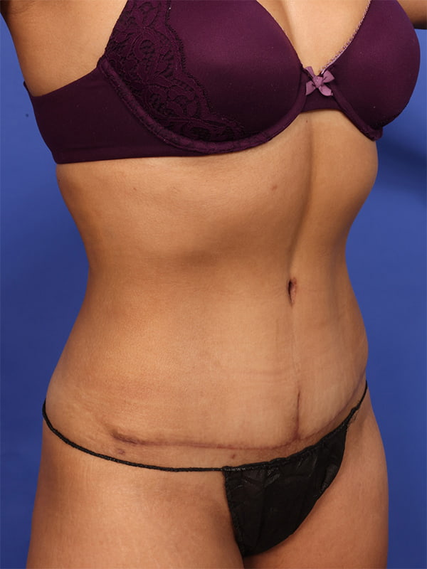 Tummy Tuck with Hernia Repair Before & After Image