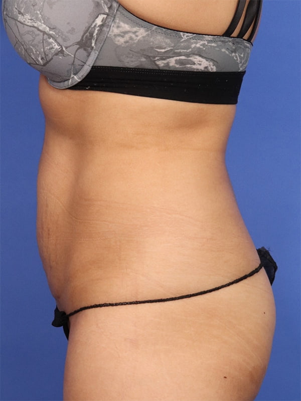 Tummy Tuck with Hernia Repair Before & After Image