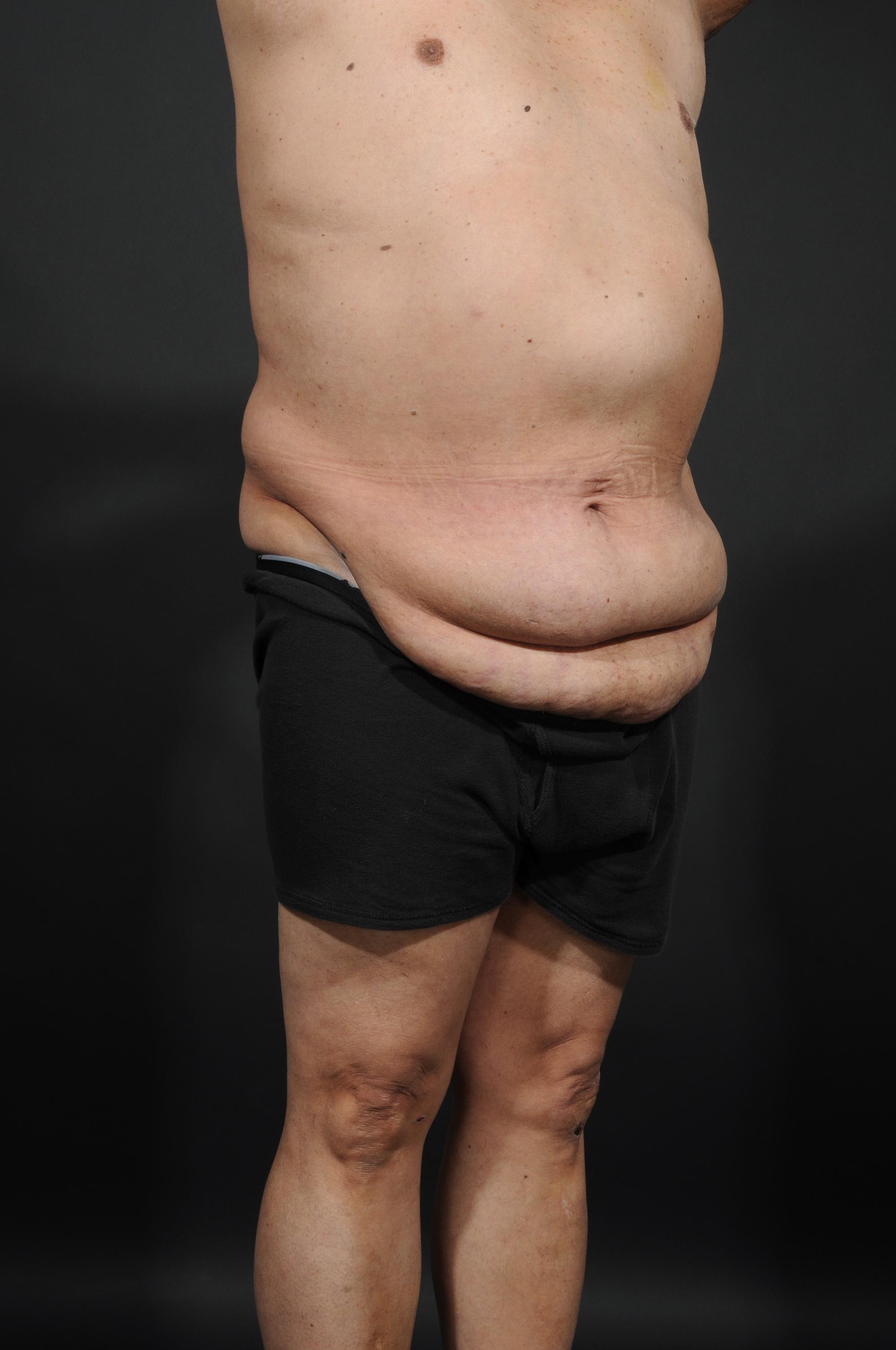 Tummy Tuck with Hernia Repair Before & After Image