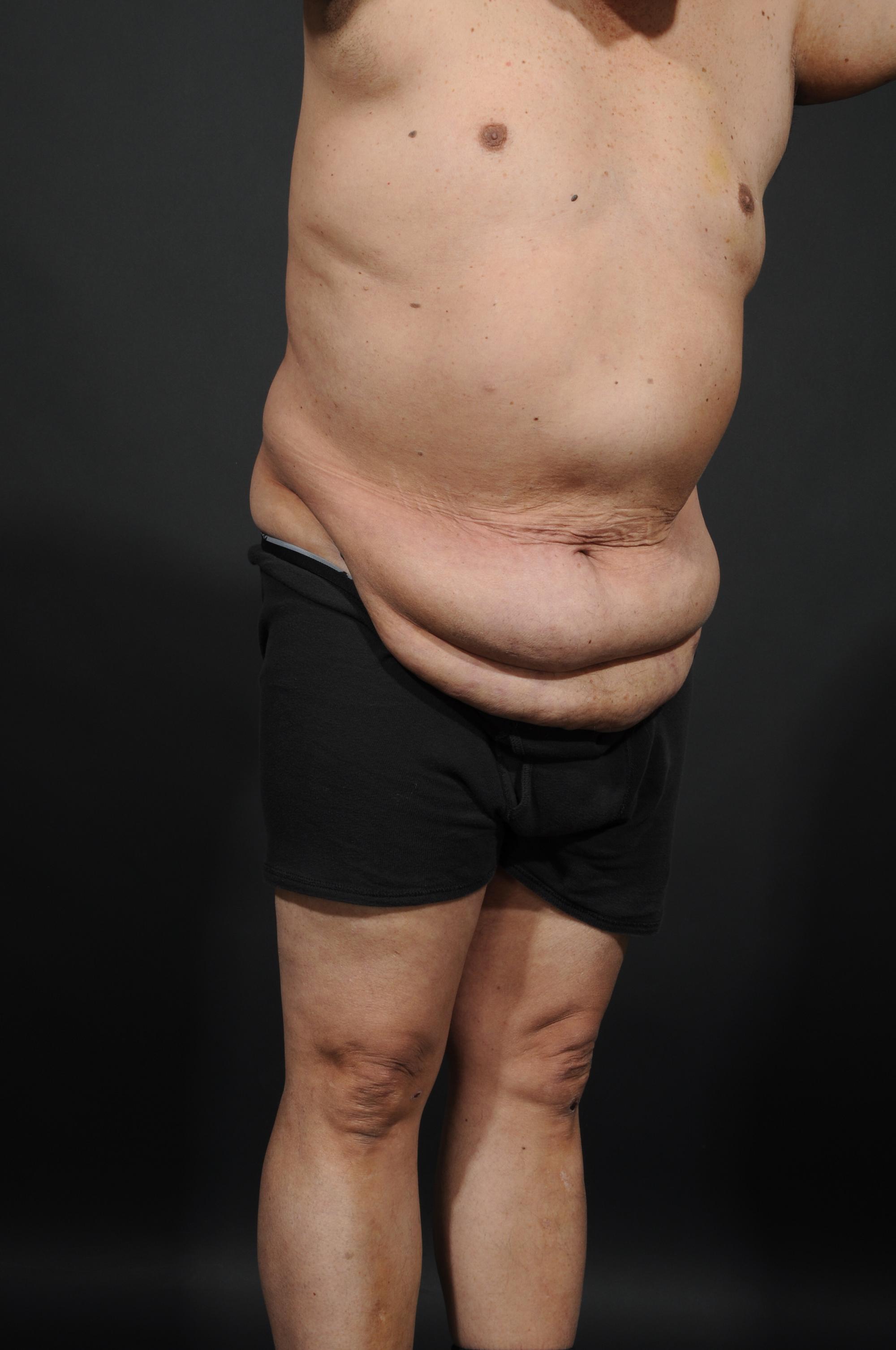 Tummy Tuck with Hernia Repair Before & After Image